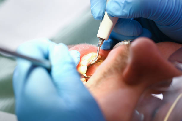 Best Emergency Tooth Extraction in Sumner, IL
